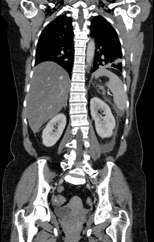 Acute pancreatitis (Radiopaedia 80007-93285 Coronal C+ portal venous phase 108).jpg