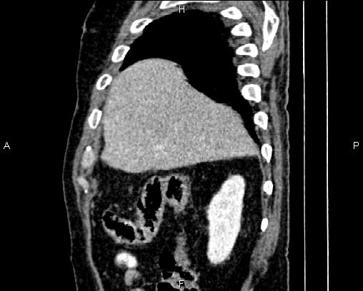 Acute pancreatitis (Radiopaedia 85146-100701 Sagittal C+ portal venous phase 15).jpg
