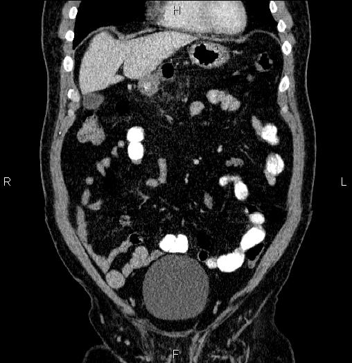 Acute pancreatitis (Radiopaedia 85390-101010 Coronal C+ portal venous phase 17).jpg
