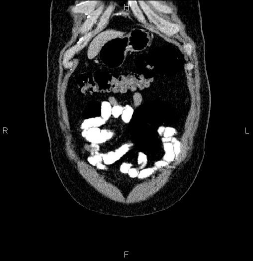 Acute pancreatitis (Radiopaedia 85390-101010 Coronal C+ portal venous phase 4).jpg