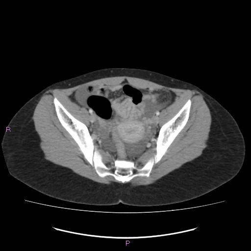 File:Acute pancreatitis secondary to stone at minor papilla and pancreatic divisum (Radiopaedia 76570-88333 Axial C+ portal venous phase 66).jpg