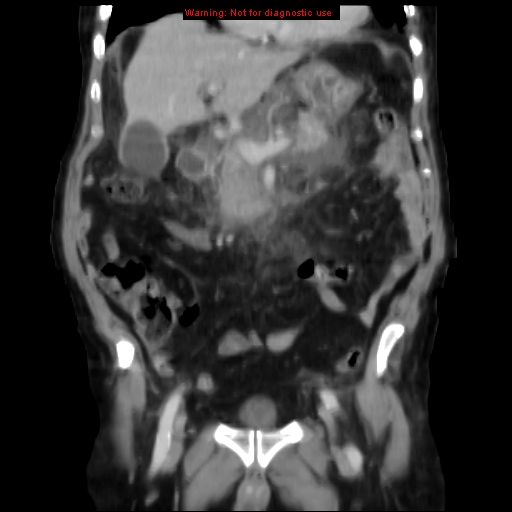 Acute pancreatitis with incidental pancreatic lipoma (Radiopaedia 10190-10730 Coronal C+ portal venous phase 27).jpg