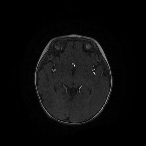 Acute phase of hemiconvulsion-hemiplegia epilepsy syndrome (Radiopaedia 29309-29745 Axial TOF angiography 67).jpg
