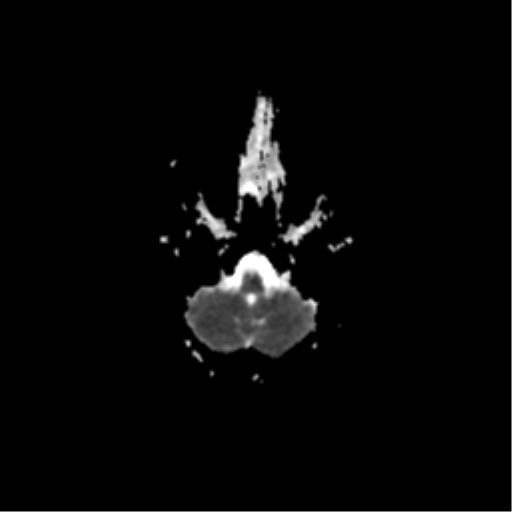 File:Acute pontine infarct from vertebral artery dissection (Radiopaedia 34111-35370 Axial ADC 4).png