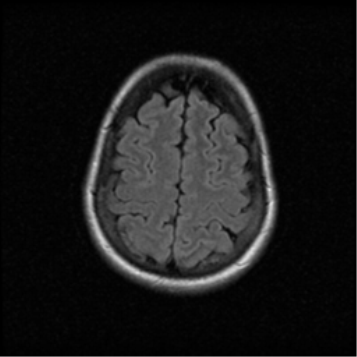 File:Acute pontine infarct from vertebral artery dissection (Radiopaedia 34111-35370 Axial FLAIR 18).png