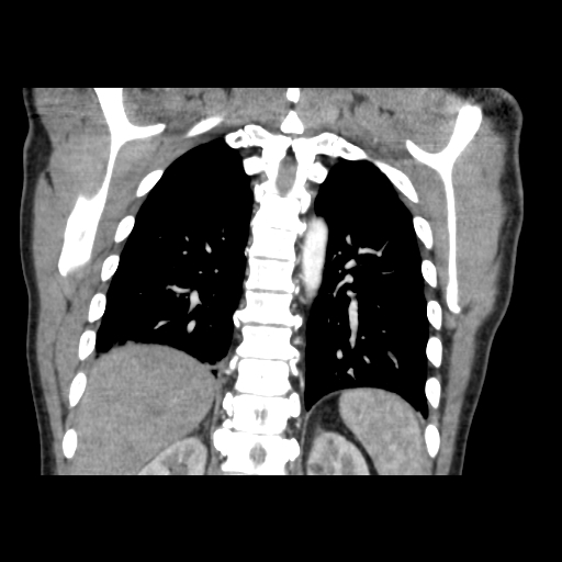 Acute segmental pulmonary emboli and pulmonary infarction (Radiopaedia 62264-70444 Coronal C+ CTPA 42).jpg