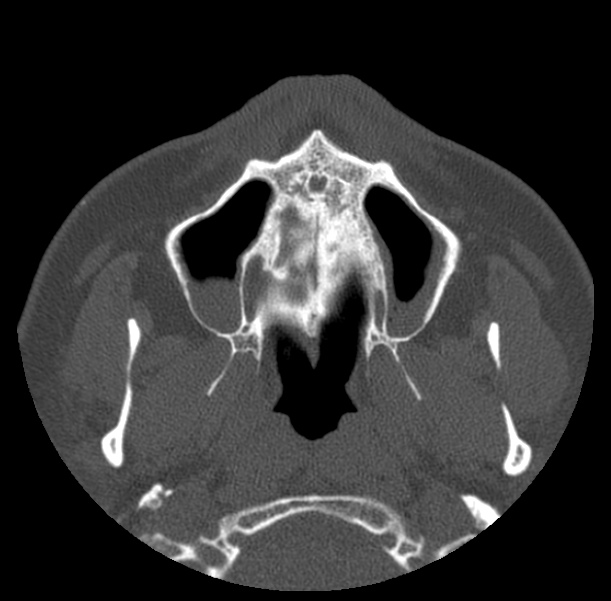 Acute sinusitis (Radiopaedia 23161-23215 Axial bone window 11).jpg