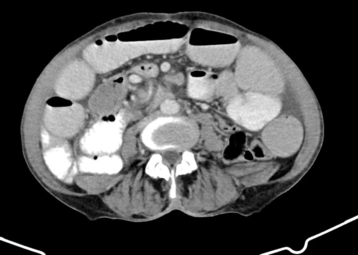 Acute small bowel (ileal) volvulus (Radiopaedia 71740-82139 Axial C+ portal venous phase 119).jpg