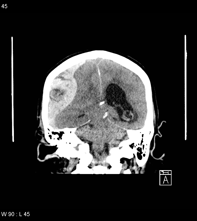 Acute subdural hematoma with myelofibrosis (Radiopaedia 52582-58494 Coronal non-contrast 36).jpg
