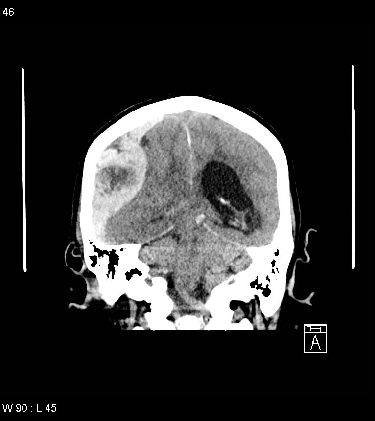 Acute subdural hematoma with myelofibrosis (Radiopaedia 52582-58494 Coronal non-contrast 37).jpg