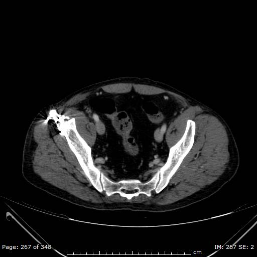 Acute superior mesenteric artery occlusion (Radiopaedia 43636-47060 Axial C+ portal venous phase 53).jpg