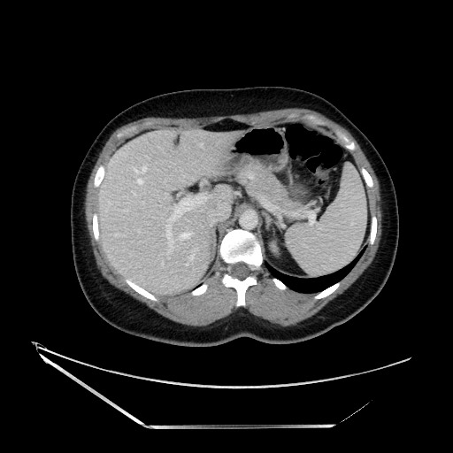 Acute uncomplicated appendicitis (Radiopaedia 73704-84499 Axial C+ portal venous phase 38).jpg