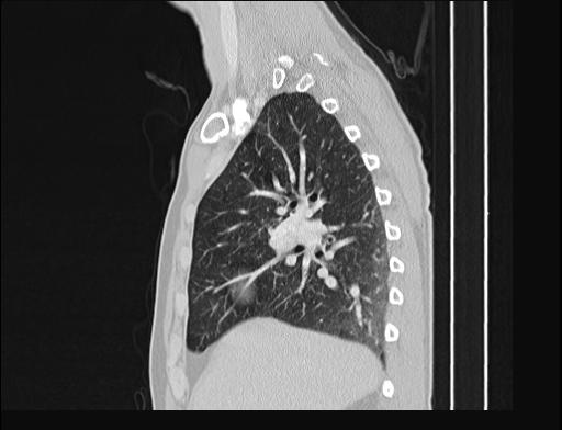 File:Addison disease (Radiopaedia 49318-54412 Sagittal lung window 42).jpg