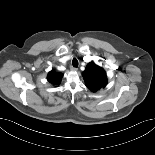 Adenocarcioma of rectum- T1 lesion (Radiopaedia 36921-38547 Axial C+ arterial phase 10).png