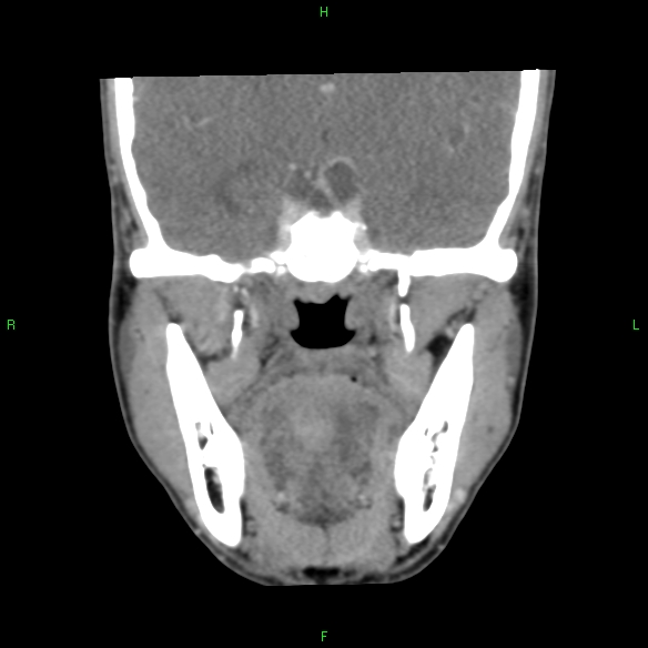 File:Adenoid cystic carcinoma of hard palate (Radiopaedia 26137-26273 Coronal liver window 18).jpg