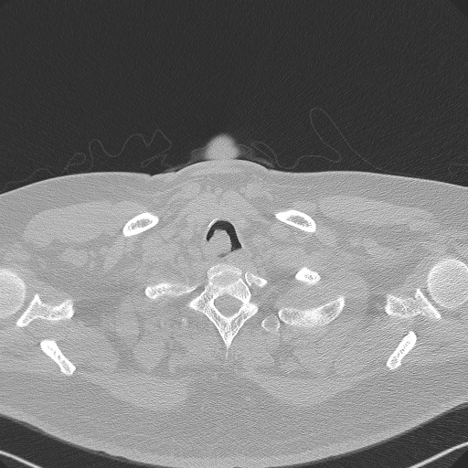 Adenoid cystic carcinoma of the trachea (Radiopaedia 49042-54137 Axial lung window 16).jpg