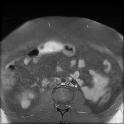 File:Adenomyosis within a didelphys uterus (Radiopaedia 70175-80215 Axial T1 C+ fat sat 2).jpg