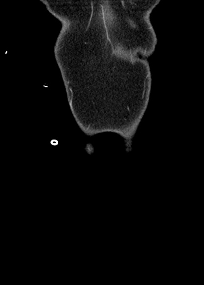 Adhesional small bowel obstruction (Radiopaedia 48397-53305 Coronal C+ portal venous phase 13).jpg