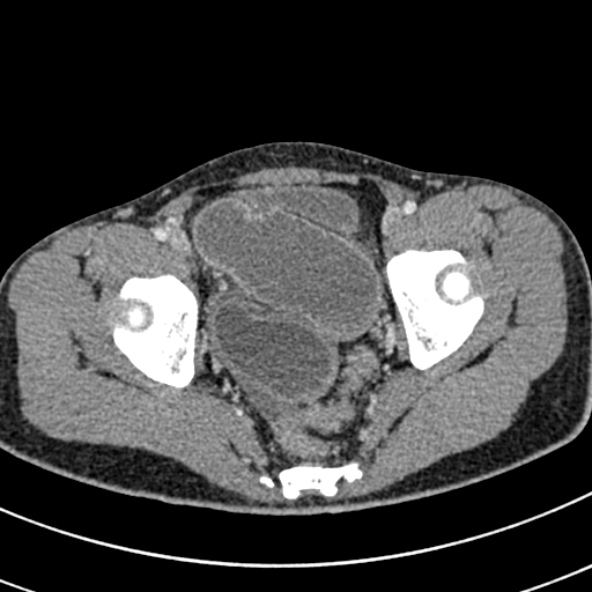 File:Adhesional small bowel obstruction (Radiopaedia 52107-57980 Axial C+ portal venous phase 115).jpg