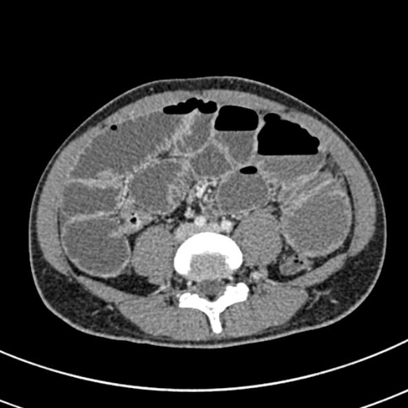 Adhesional small bowel obstruction (Radiopaedia 52107-57980 Axial C+ portal venous phase 78).jpg