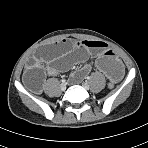 File:Adhesional small bowel obstruction (Radiopaedia 52107-57980 Axial C+ portal venous phase 87).jpg