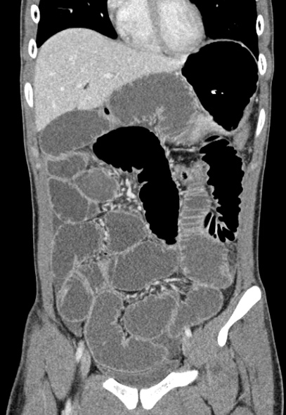 File:Adhesional small bowel obstruction (Radiopaedia 52107-57980 Coronal C+ portal venous phase 25).jpg