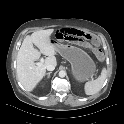 Adhesions within abdominal wall hernia (Radiopaedia 58283-65394 Axial C+ portal venous phase 22).png
