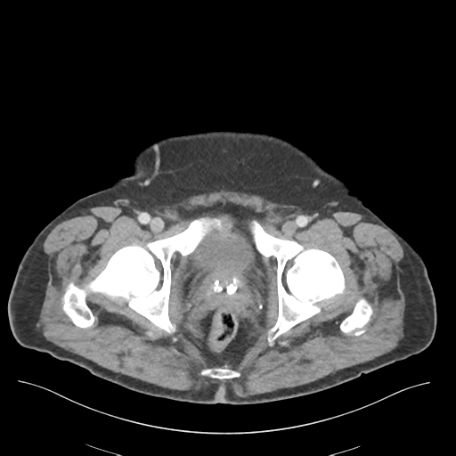 Adhesions within abdominal wall hernia (Radiopaedia 58283-65394 Axial C+ portal venous phase 81).png