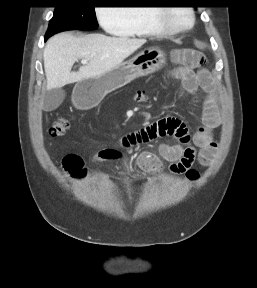 File:Adhesions within abdominal wall hernia (Radiopaedia 58283-65394 Coronal C+ portal venous phase 24).png