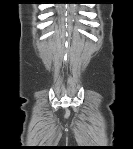 Adhesions within abdominal wall hernia (Radiopaedia 58283-65394 Coronal C+ portal venous phase 61).png