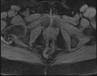 File:Adnexal multilocular cyst (O-RADS US 3. O-RADS MRI 3) (Radiopaedia 87426-103754 Axial 210).jpeg