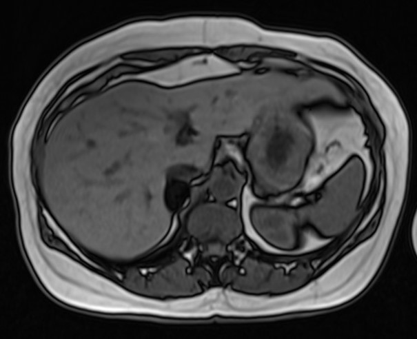 File:Adrenal adenoma (chemical shift imaging) (Radiopaedia 14341-14253 Axial T1 out-of-phase 1).jpg