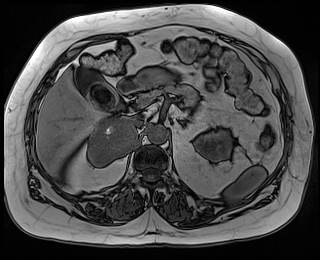 File:Adrenal cortical carcinoma (Radiopaedia 64017-72770 Axial T1 out-of-phase 28).jpg