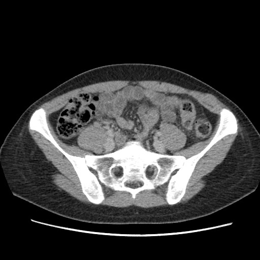 Adrenal cyst (Radiopaedia 64869-73813 Axial C+ portal venous phase 56).jpg