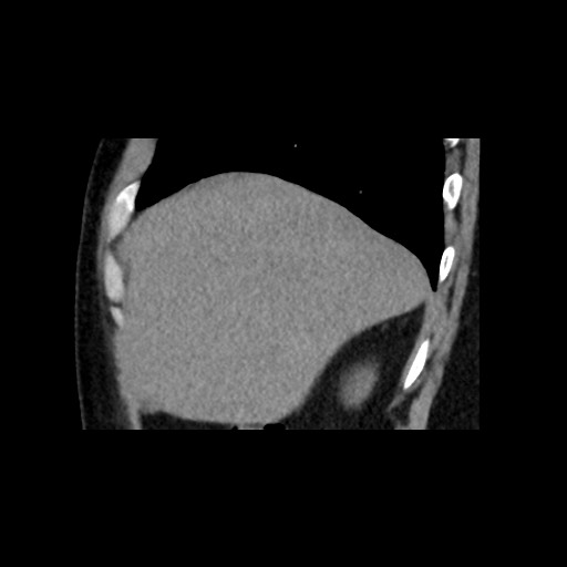 File:Adrenal gland trauma (Radiopaedia 81351-95079 Sagittal non-contrast 18).jpg