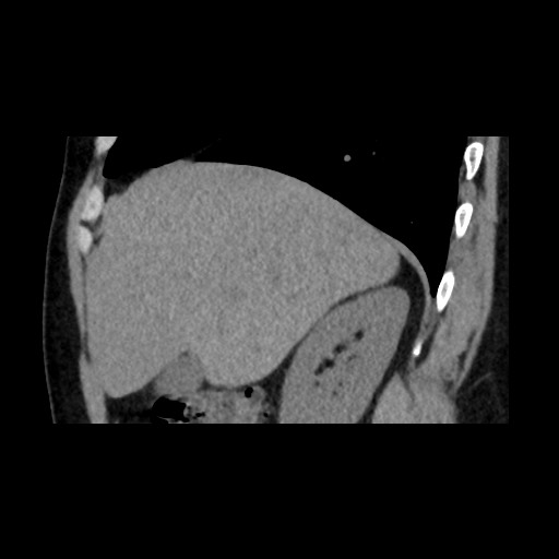 File:Adrenal gland trauma (Radiopaedia 81351-95079 Sagittal non-contrast 27).jpg