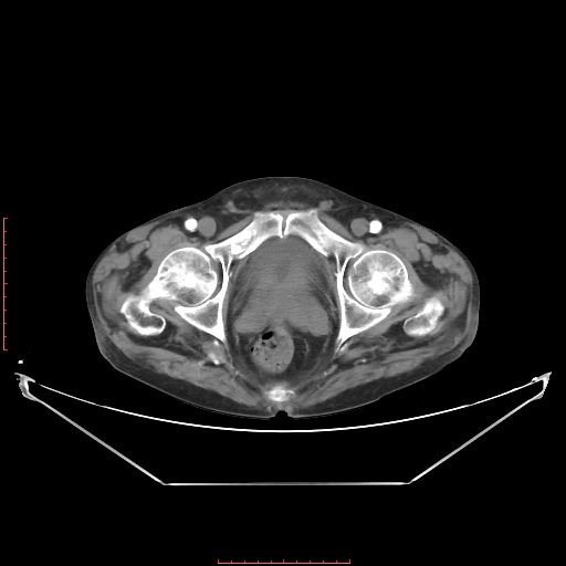 Adrenal hemangioma (Radiopaedia 68923-78668 Axial C+ arterial phase 70).jpg