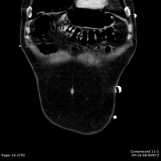 File:Adrenal metastasis (Radiopaedia 78425-91079 Sagittal C+ portal venous phase 3).jpg