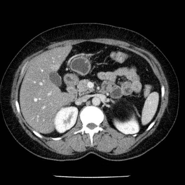 Adrenal myelolipoma (Radiopaedia 43401-46759 Axial C+ portal venous phase 30).jpg