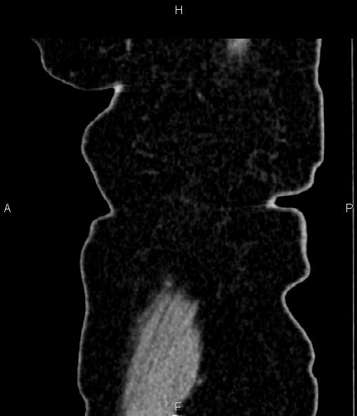 Adrenal myelolipoma (Radiopaedia 82742-96986 Sagittal renal cortical phase 104).jpg