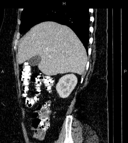 Adrenal myelolipoma (Radiopaedia 84319-99617 Sagittal renal cortical phase 22).jpg