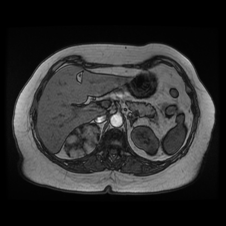 File:Adrenal myelolipoma - MRI (Radiopaedia 83249-97646 T1 out-of-phase 8).jpg
