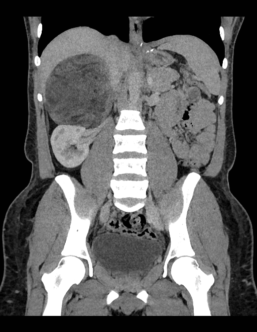Adrenal myelolipoma - bilateral (Radiopaedia 74805-85810 Coronal C+ portal venous phase 140).jpg