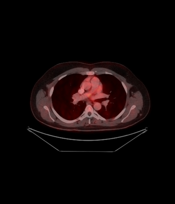 Adrenocortical carcinoma (Radiopaedia 80134-93440 ِAxial 114).jpg