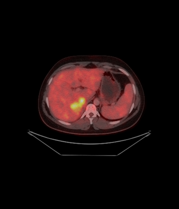 Adrenocortical carcinoma (Radiopaedia 80134-93440 ِAxial 151).jpg