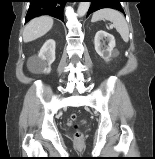 Adult ileal intussusception with secondary obstruction (Radiopaedia 30395-31051 Coronal C+ portal venous phase 44).jpg