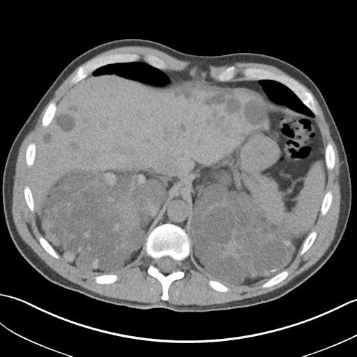 File:Adult polycystic kidney disease (Radiopaedia 47866-52626 Axial non-contrast 14).png