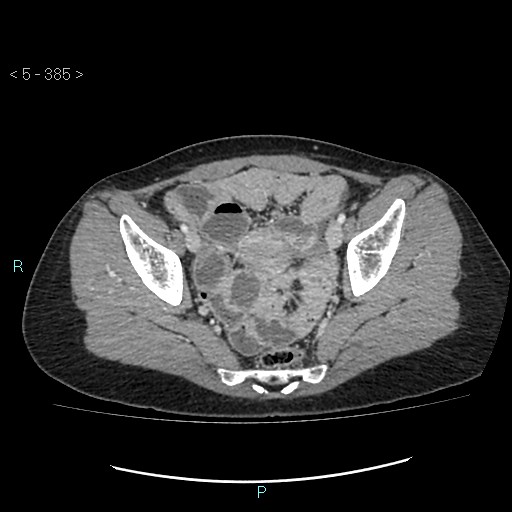 Adult transient intestinal intussusception (Radiopaedia 34853-36310 Axial C+ portal venous phase 98).jpg