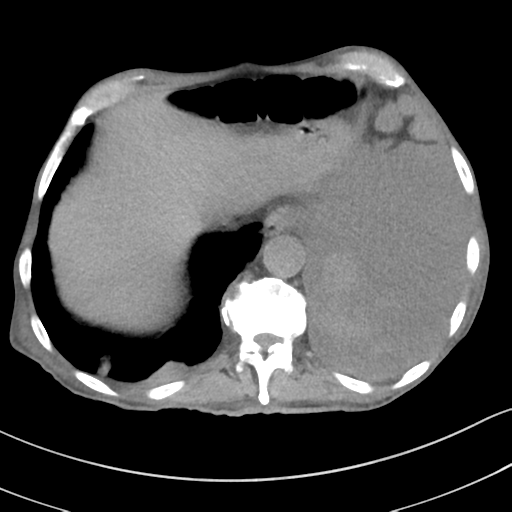 Advanced metastatic lung cancer (Radiopaedia 48910-53954 Axial non-contrast 54).png