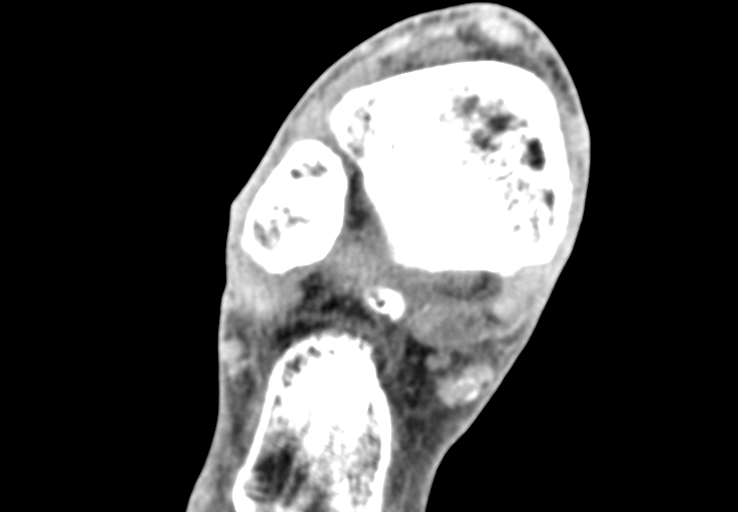 Advanced osteomyelitis due to open metatarsal fracture (Radiopaedia 83891-99095 Axial non-contrast 2).jpg